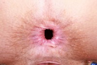 ATK hairy  in mature and hairy