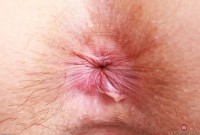 ATK hairy  in mature and hairy