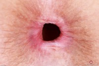 ATK hairy  in mature and hairy