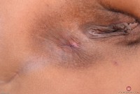 ATK hairy  in young and hairy