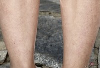 ATK hairy  in young and hairy