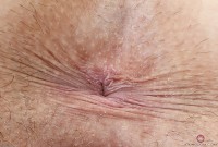 ATK hairy  in mature and hairy