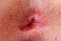 ATK hairy  in young and hairy