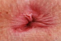 ATK hairy  in young and hairy