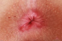 ATK hairy  in young and hairy