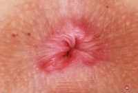 ATK hairy  in young and hairy