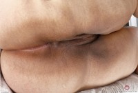 ATK hairy  in mature and hairy