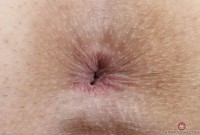 ATK hairy  in young and hairy