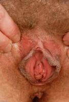ATK hairy  in mature and hairy