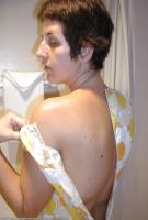 ATK hairy  in mature and hairy