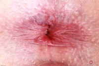 ATK hairy  in young and hairy