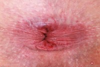 ATK hairy  in young and hairy