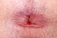 ATK hairy  in young and hairy