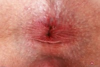 ATK hairy  in young and hairy