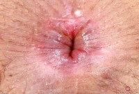 ATK hairy  in exotic and hairy