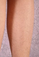 ATK hairy  in young and hairy