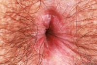 ATK hairy  in young and hairy