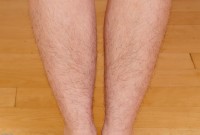 ATK hairy  in young and hairy