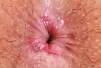 ATK hairy  in young and hairy