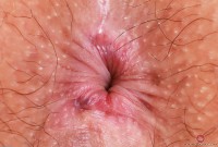 ATK hairy  in young and hairy