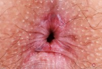 ATK hairy  in young and hairy