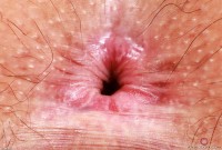 ATK hairy  in young and hairy