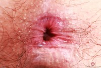 ATK hairy  in young and hairy