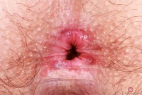 ATK hairy  in young and hairy