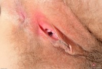 ATK hairy  in mature and hairy