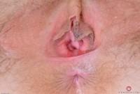 ATK hairy  in mature and hairy