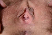 ATK hairy  in mature and hairy
