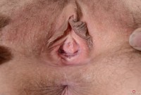 ATK hairy  in mature and hairy