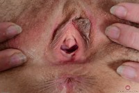 ATK hairy  in mature and hairy