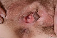 ATK hairy  in mature and hairy