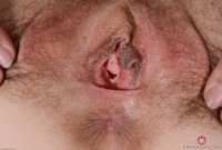 ATK hairy  in mature and hairy