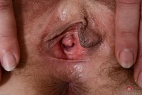 ATK hairy  in mature and hairy