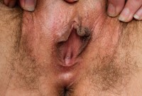 ATK hairy  in mature and hairy