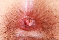 ATK hairy  in mature and hairy