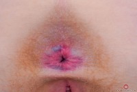 ATK hairy  in young and hairy