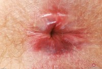 ATK hairy  in mature and hairy