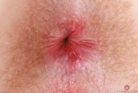 ATK hairy  in mature and hairy