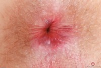 ATK hairy  in mature and hairy