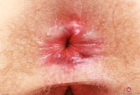 ATK hairy  in mature and hairy