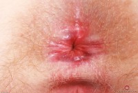 ATK hairy  in mature and hairy