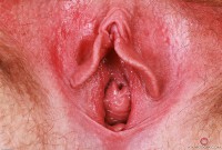 ATK hairy  in mature and hairy
