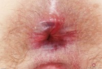 ATK hairy  in mature and hairy