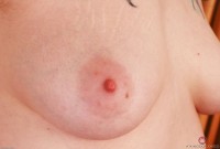 ATK hairy  in mature and hairy