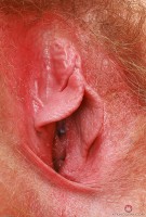 ATK hairy  in mature and hairy