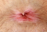 ATK hairy  in young and hairy