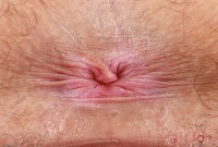 ATK hairy  in young and hairy